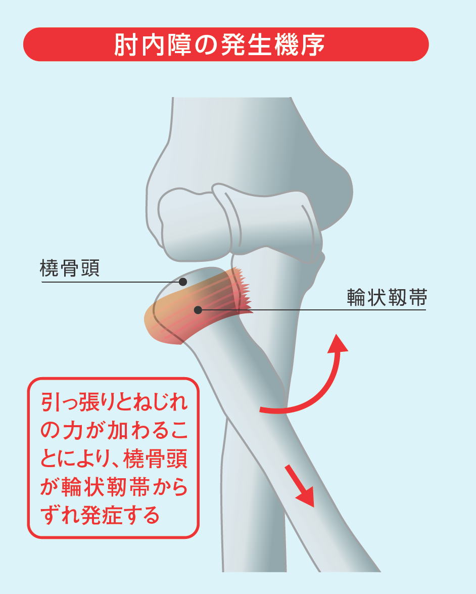 肘内障 日本臨床整形外科学会